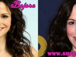 mary louise parker plastic surgery