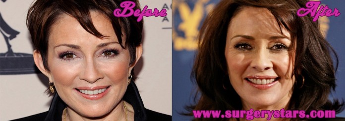 patricia heaton plastic surgery