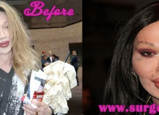 pete burns plastic surgery