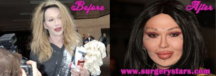 pete burns plastic surgery