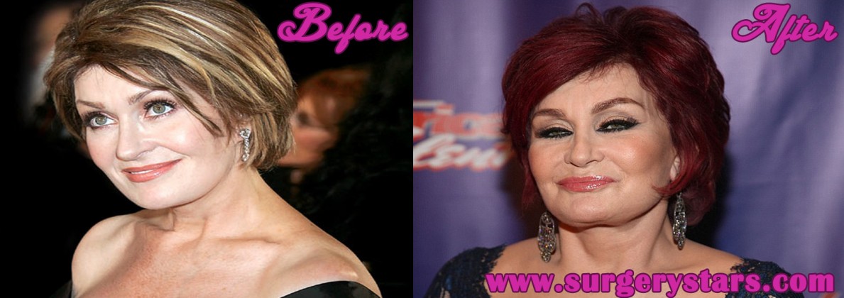 Sharon Osbourne Plastic Surgery - Before And After Shoots