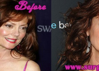 susan sarandon plastic surgery