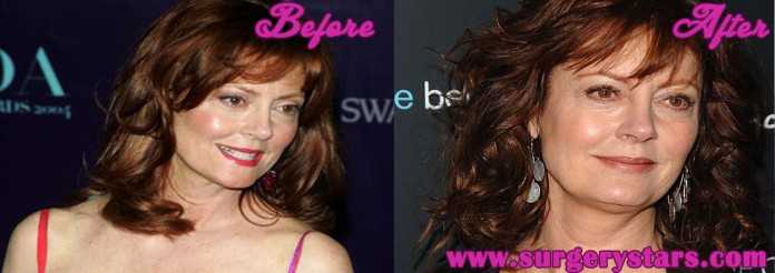 susan sarandon plastic surgery