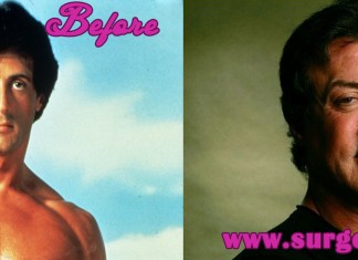 sylvester stallone plastic surgery