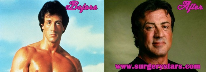 sylvester stallone plastic surgery