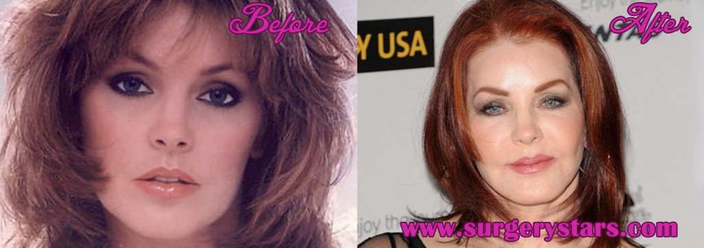 Priscilla Presley Plastic Surgery