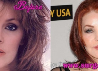 Priscilla Presley Plastic Surgery