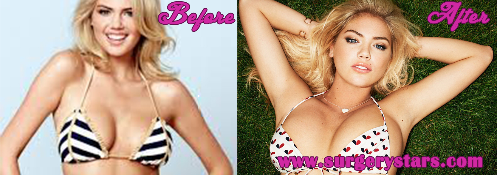 Kate Upton Breast Implants