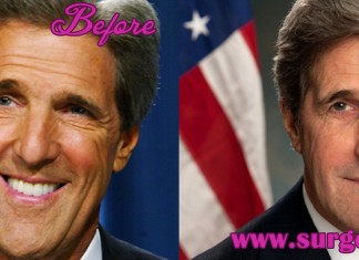 John Kerry Plastic Surgery