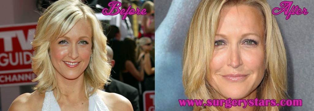 Did lara spencer have a nose job