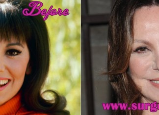 Marlo Thomas Plastic Surgery