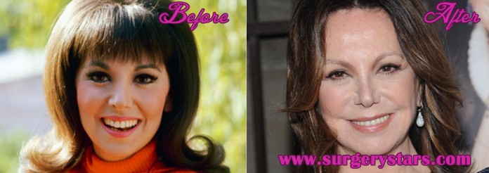 Marlo Thomas Plastic Surgery