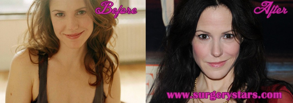 Mary Louise Parker Plastic Surgery