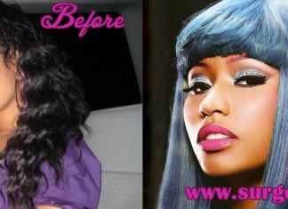 Nicki Minaj Plastic Surgery