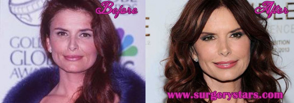 Roma Downey Plastic Surgery