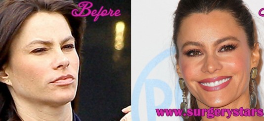 sofia vergara plastic surgery