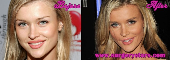 Joanna Krupa Plastic Surgery