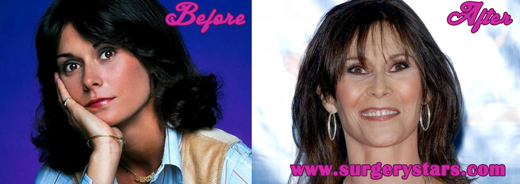 kate jackson plastic surgery before and after
