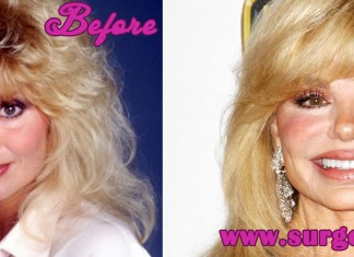 Loni Anderson Plastic Surgery