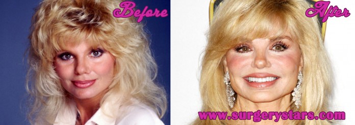 Loni Anderson Plastic Surgery