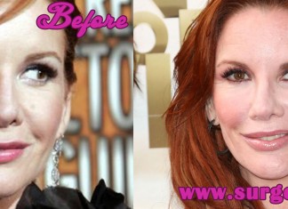 Melissa Gilbert Plastic Surgery