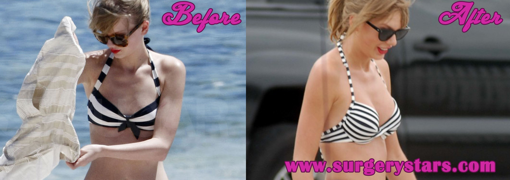 Taylor Swift Implants