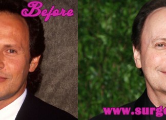 Billy Crystal Plastic Surgery