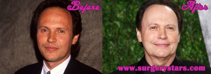 Billy Crystal Plastic Surgery