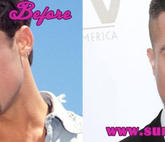Brad Pitt Plastic Surgery