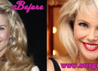 Christie Brinkley Plastic Surgery