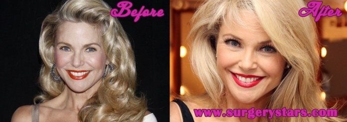 Christie Brinkley Plastic Surgery