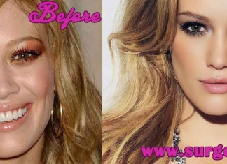 Hilary Duff Plastic Surgery