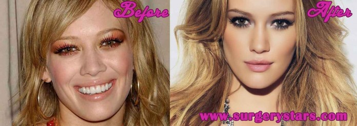 Hilary Duff Plastic Surgery