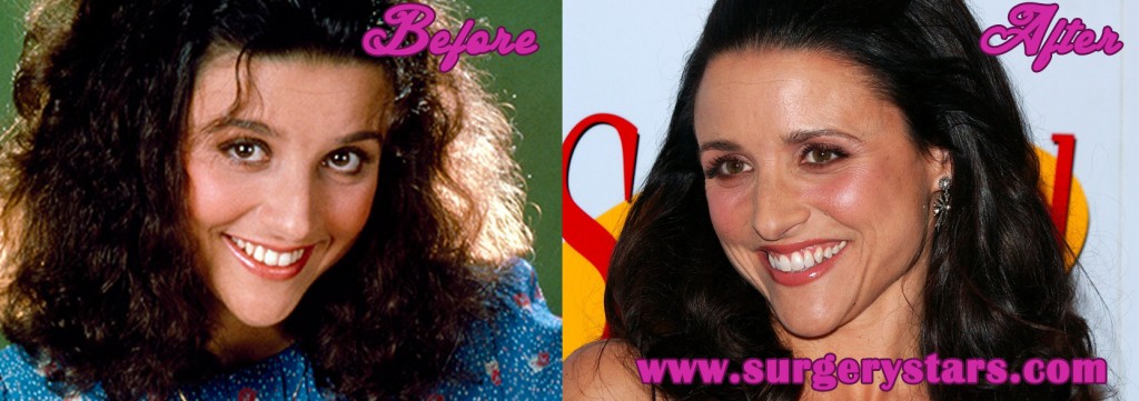 Julia Louis-Dreyfus Plastic Surgery