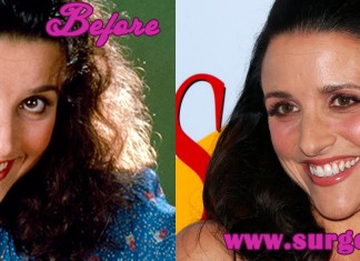 Julia Louis-Dreyfus Plastic Surgery