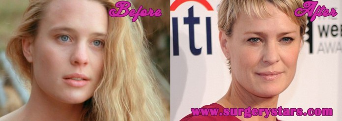 Robin Wright Plastic Surgery