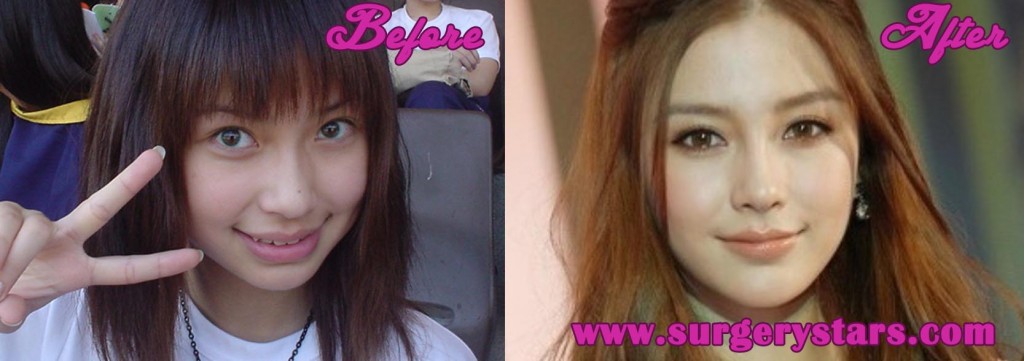 Angelababy Plastic Surgery