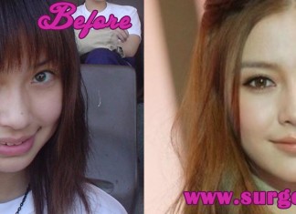 Angelababy Plastic Surgery