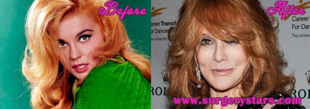 Ann Margret Plastic Surgery