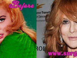 Ann Margret Plastic Surgery
