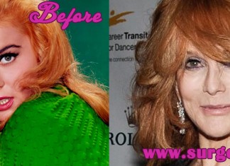 Ann Margret Plastic Surgery