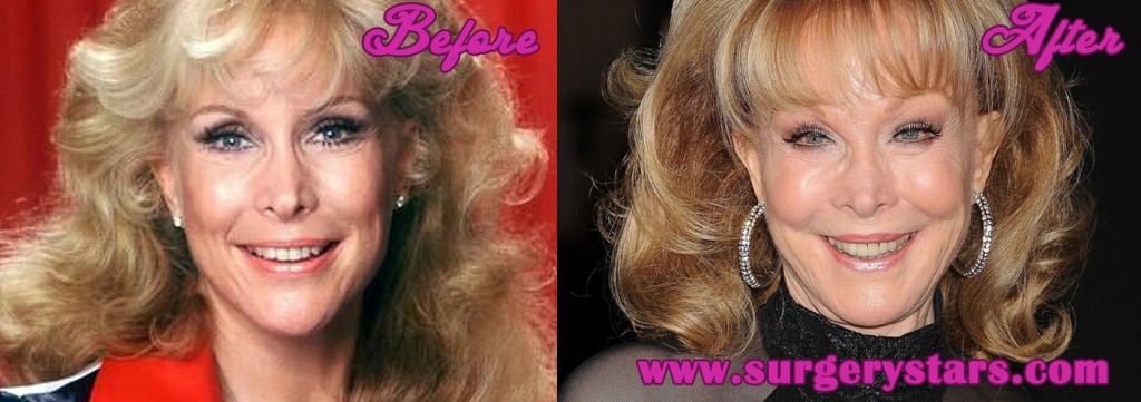 barbara eden plastic surgery