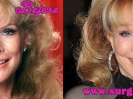 barbara eden plastic surgery