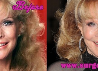 barbara eden plastic surgery