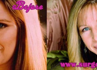 Barbra Streisand Plastic Surgery