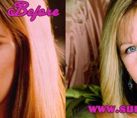 Barbra Streisand Plastic Surgery
