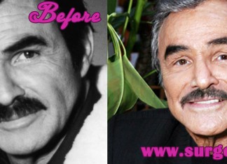 Burt Reynolds Plastic Surgery