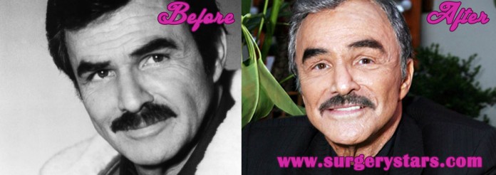 Burt Reynolds Plastic Surgery