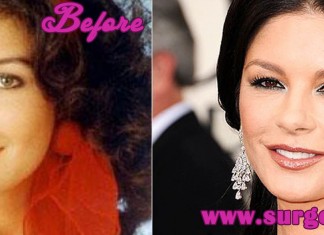 Catherine Zeta Jones Plastic Surgery