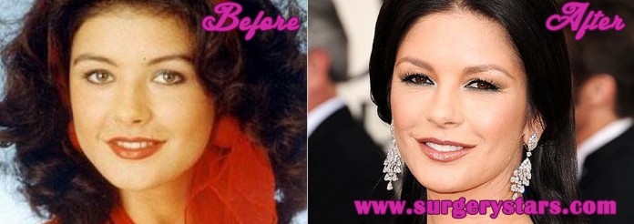 Catherine Zeta Jones Plastic Surgery